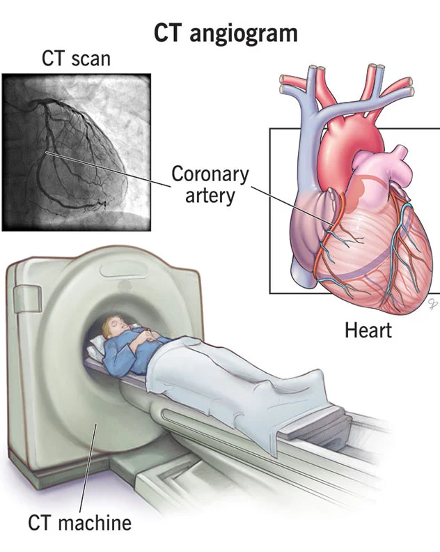 Cardiac CT Angiography (CTA)
