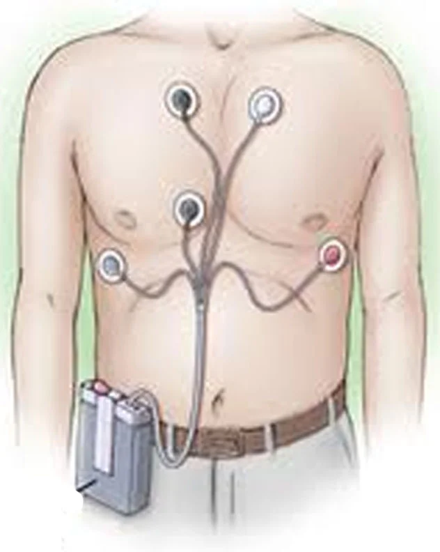Holter Monitoring