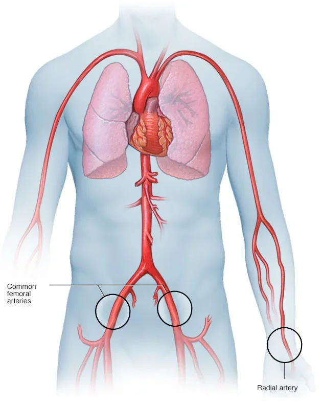 Coronary Angiography