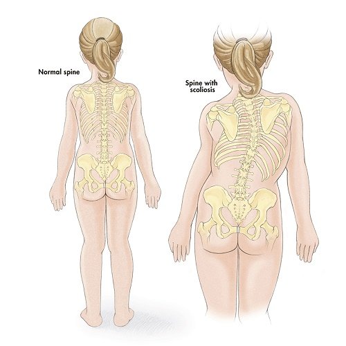 Spine & Scoliosis