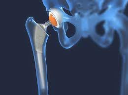 Joint Replacement Surgeon in Malviya Nagar