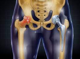 Joint Replacement Surgeon in Mansarovar