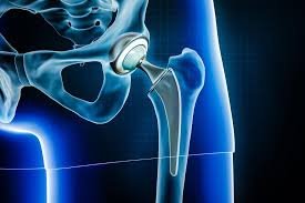 Joint Replacement Surgeon in Lal Kothi