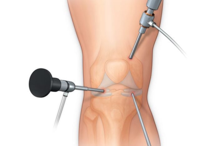 Arthroscopy And Sportsmedicine