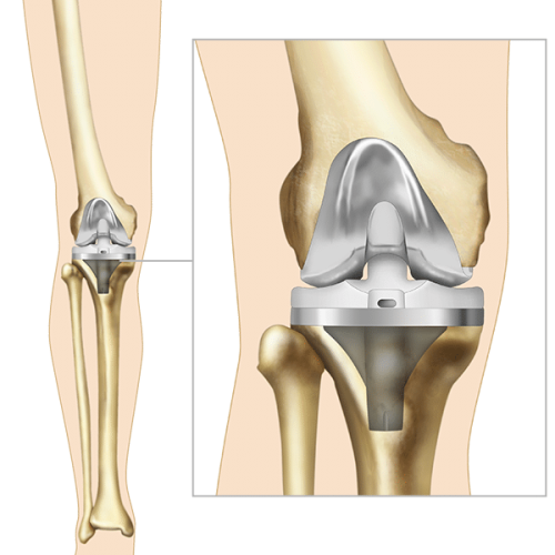 Joint Replacement